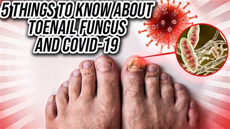 Symptoms include. . Covid and nail fungus